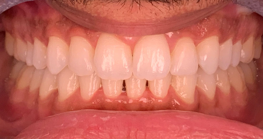 invisalign treatment houston tx