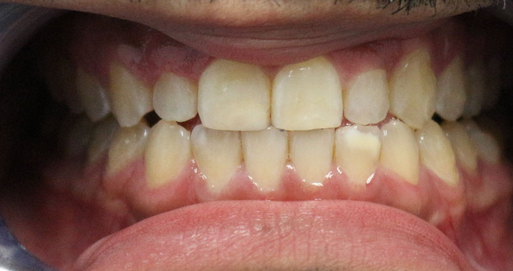 invisalign near me
