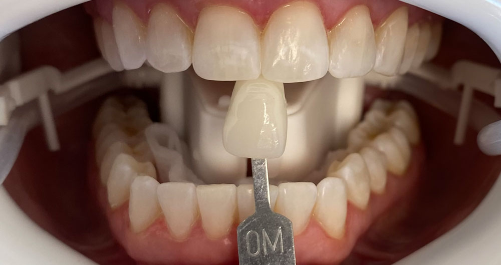teeth whitening