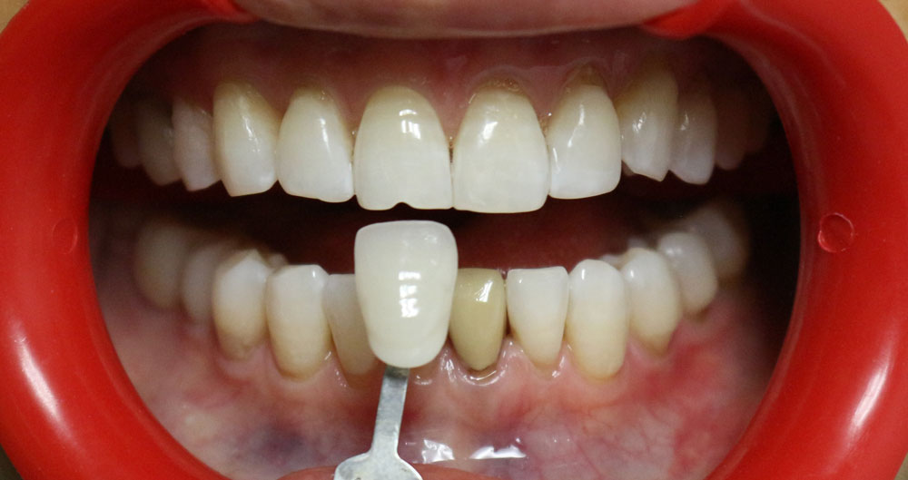 teeth whitening dentist houston tx