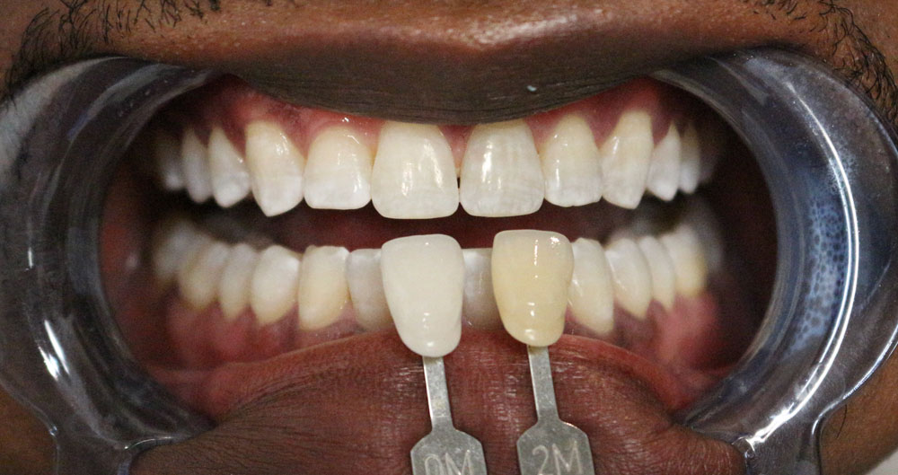 teeth whitening dentist near me