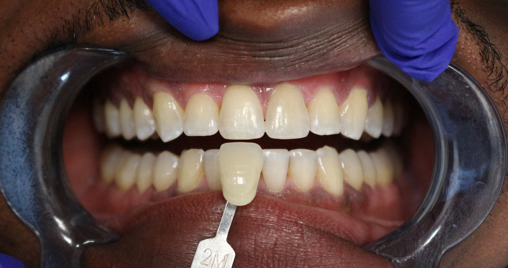 teeth whitening near me