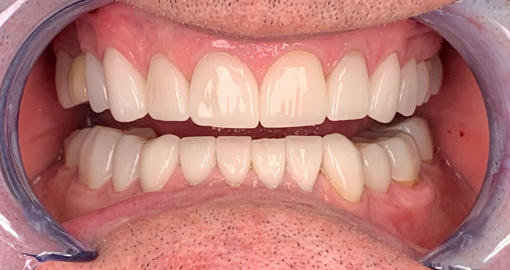 dental veneers dentist Houston tx