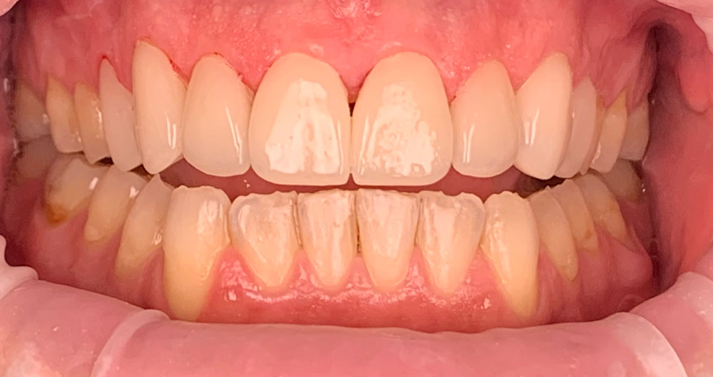 veneers near me