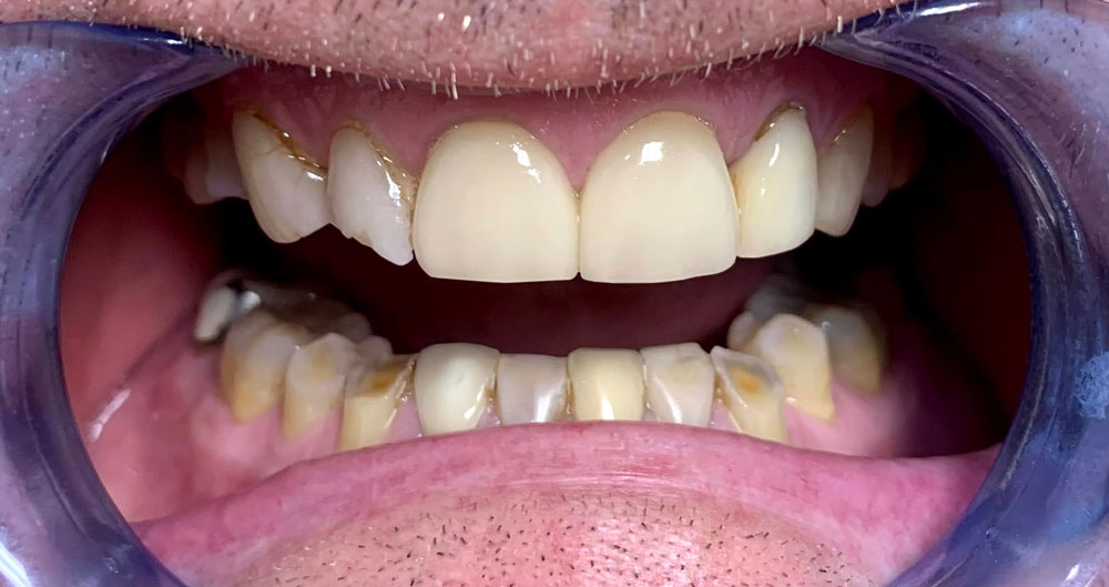 veneers cost Houston tx