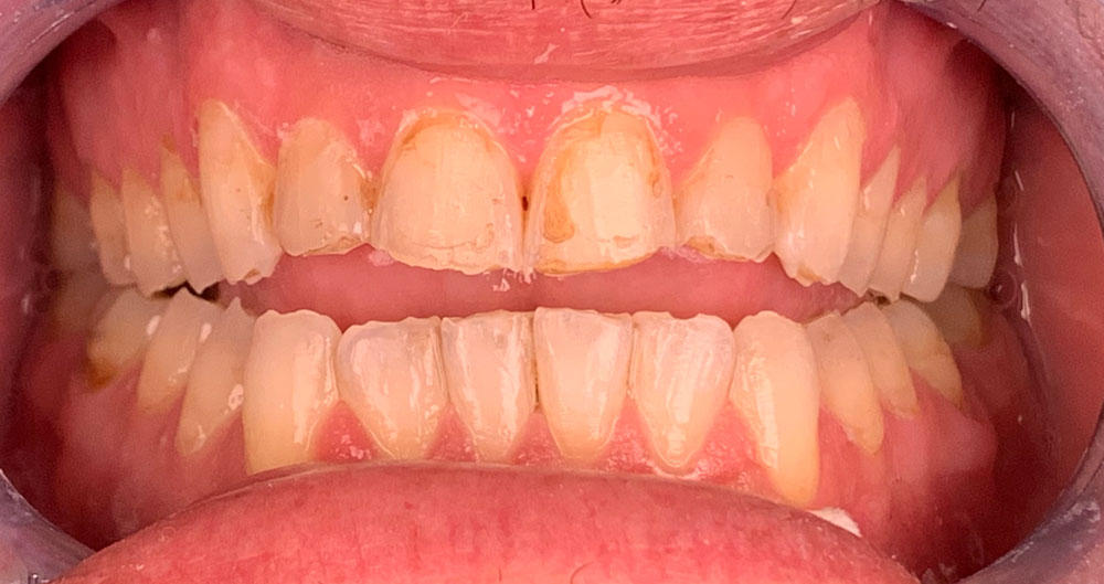 dental veneers Houston tx