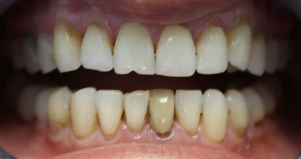 dental veneers near me